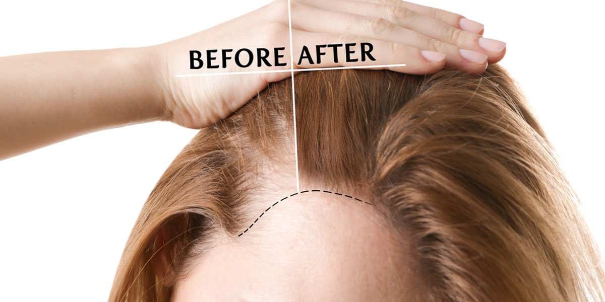 greffe-de-cheveux-femme