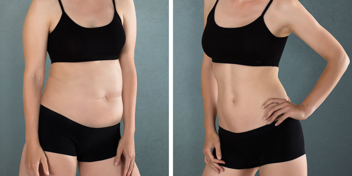 mini-abdominoplastie